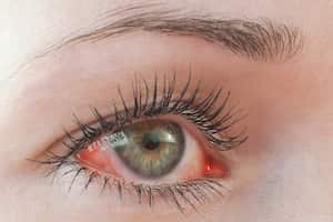 Ojo humano irritado rojo de cerca, síntoma de alergia