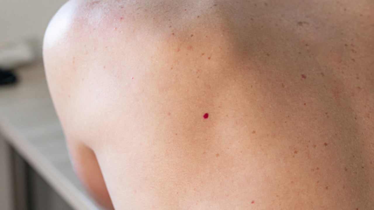 Angiomas rojas que pueden aparecer en la piel.