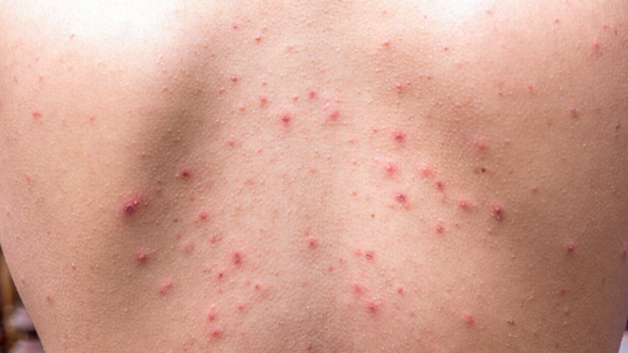 Los adultos también pueden sufrir de acné.