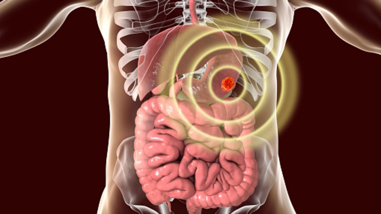 El cáncer de estómago empieza cuando las células en este órgano crecen de manera descontrolada.