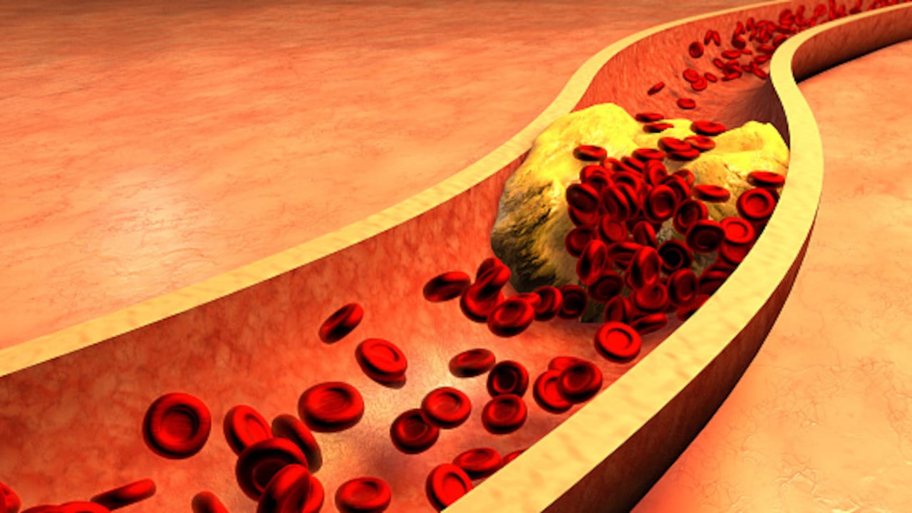 Clogged Artery with platelets and cholesterol plaque, concept for health risk for obesity or dieting and nutrition problems