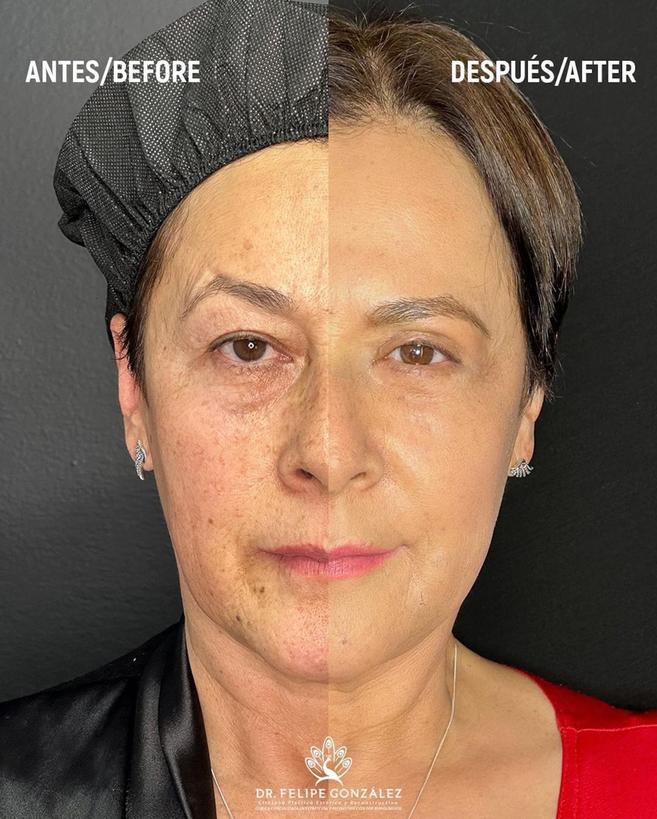 El antes y después de Alina Lozano tras someterse a una serie de procedimientos quirúrgicos.