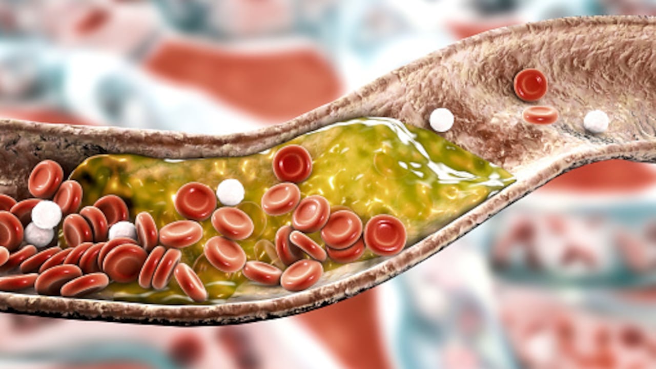 El colesterol cuando se adhiere a las arterias evita el flujo óptimo de la sangre.