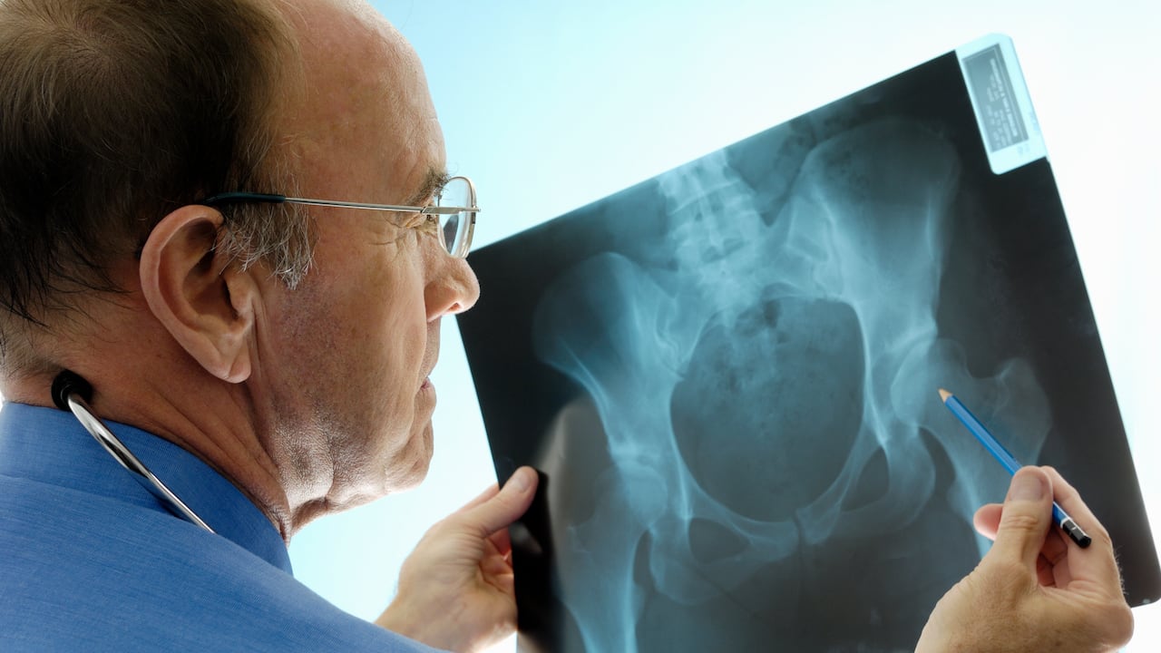 La osteoporosis se puede presentar por la falta de calcio.