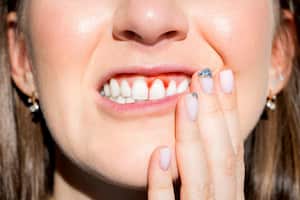 La gingivitis puede llevar a una enfermedad de las encías mucho más grave, llamada periodontitis, y a la pérdida de dientes.