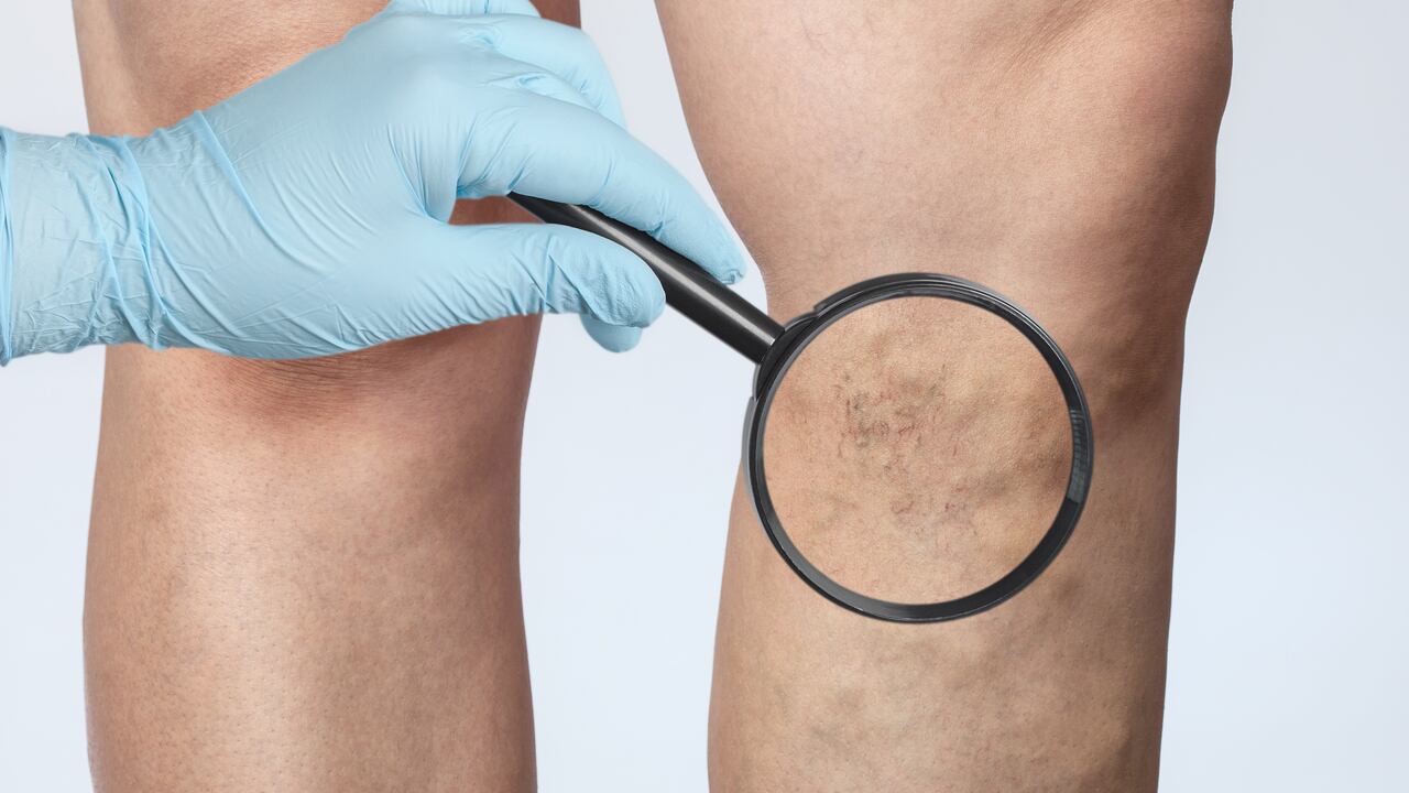 venas hinchadas y retorcidas que pueden verse bajo la piel y suelen aparecer en las piernas.
