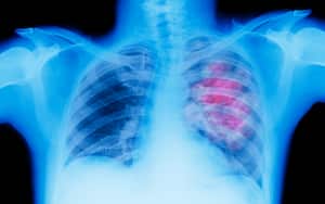 Radiografía de pulmón que muestra cáncer de pecho