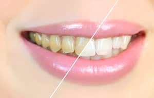 El blanqueamiento dental profesional se promociona como la solución definitiva para lograr una sonrisa más blanca.