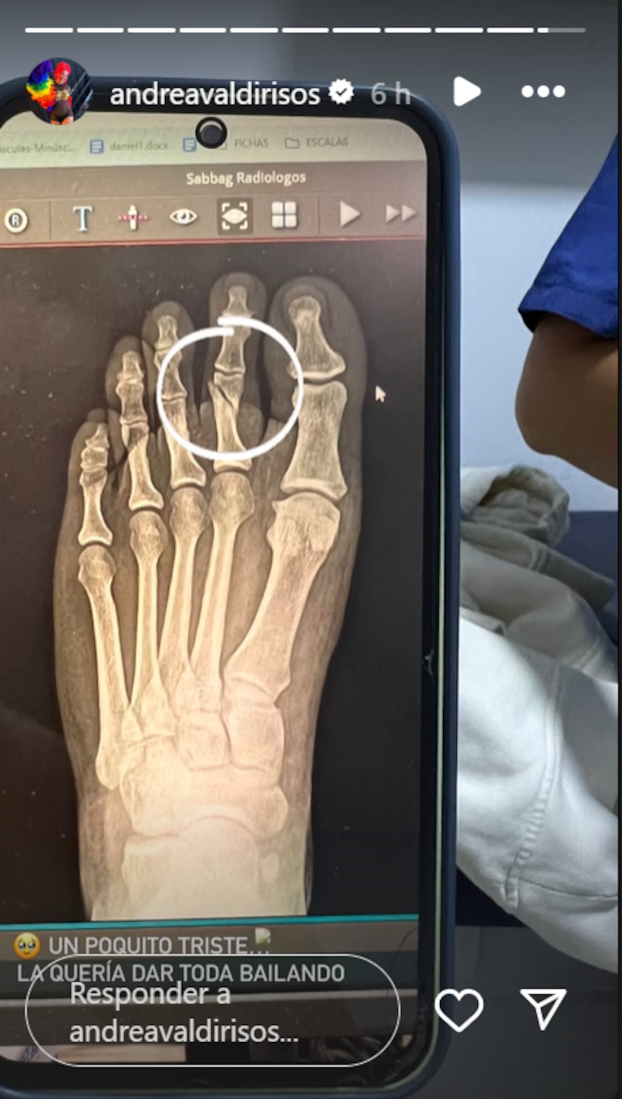 Andrea Valdiri se fracturó un de los dedos de su pie derecho.
