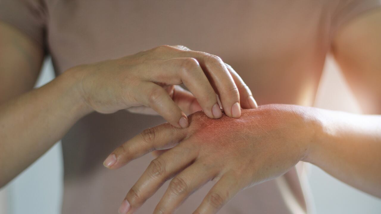 Aunque poco común, las mordeduras de cucarachas pueden causar irritación y picazón en la piel afectada.